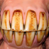 Le syndrome odontoclastique